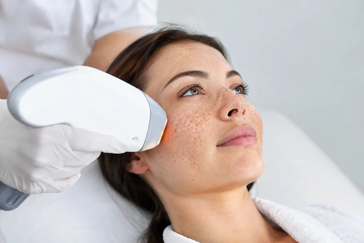 Is IPL Safe for Freckles? Before You Treat