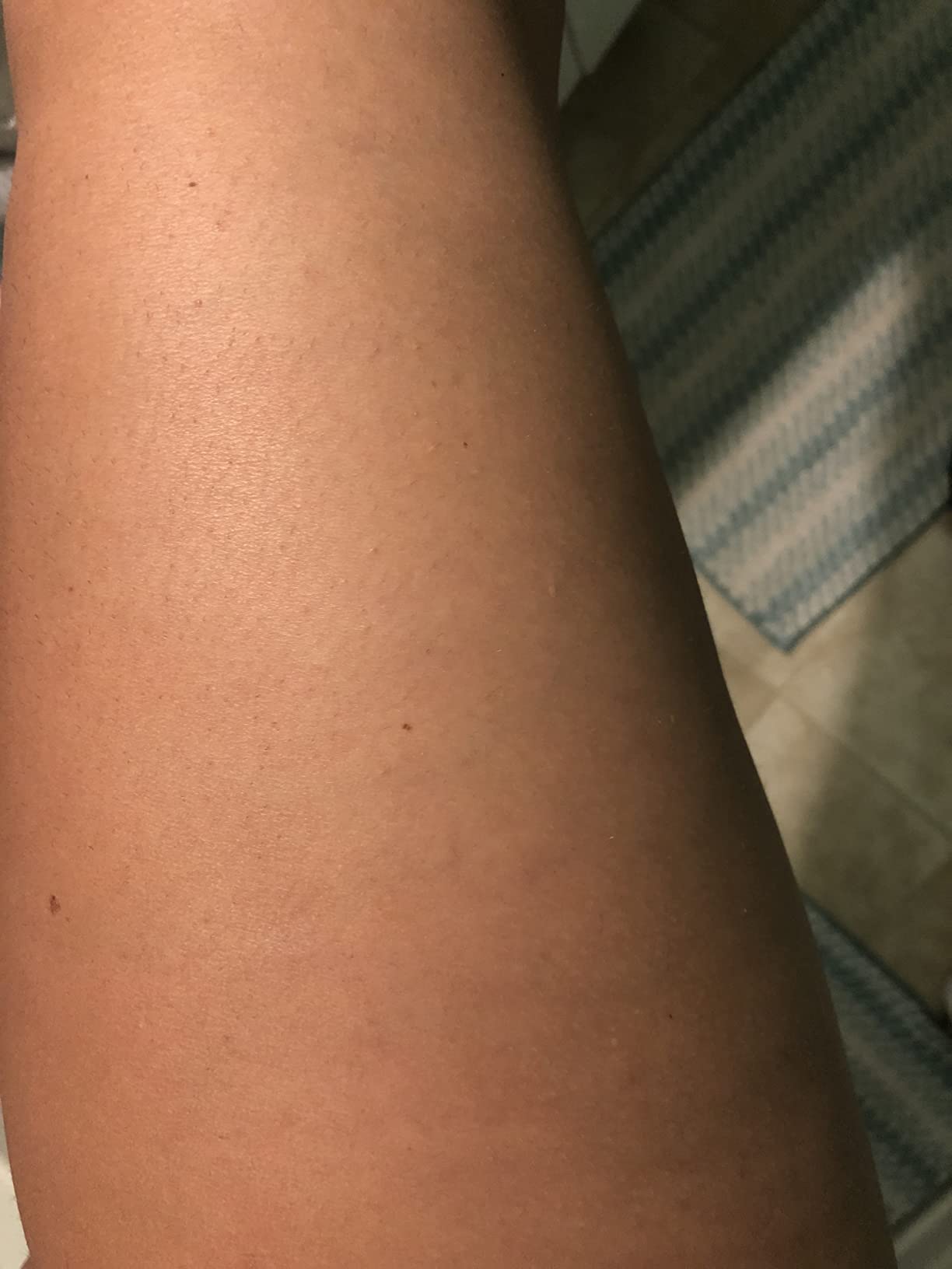 best laser hair removal device